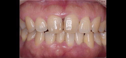 軽度の歯周病-1