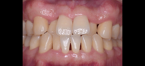 中等度の歯周病-1
